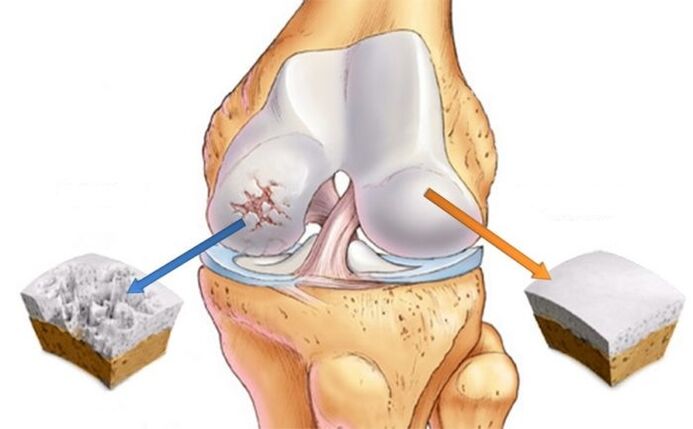 cartilage sain et arthrose du genou