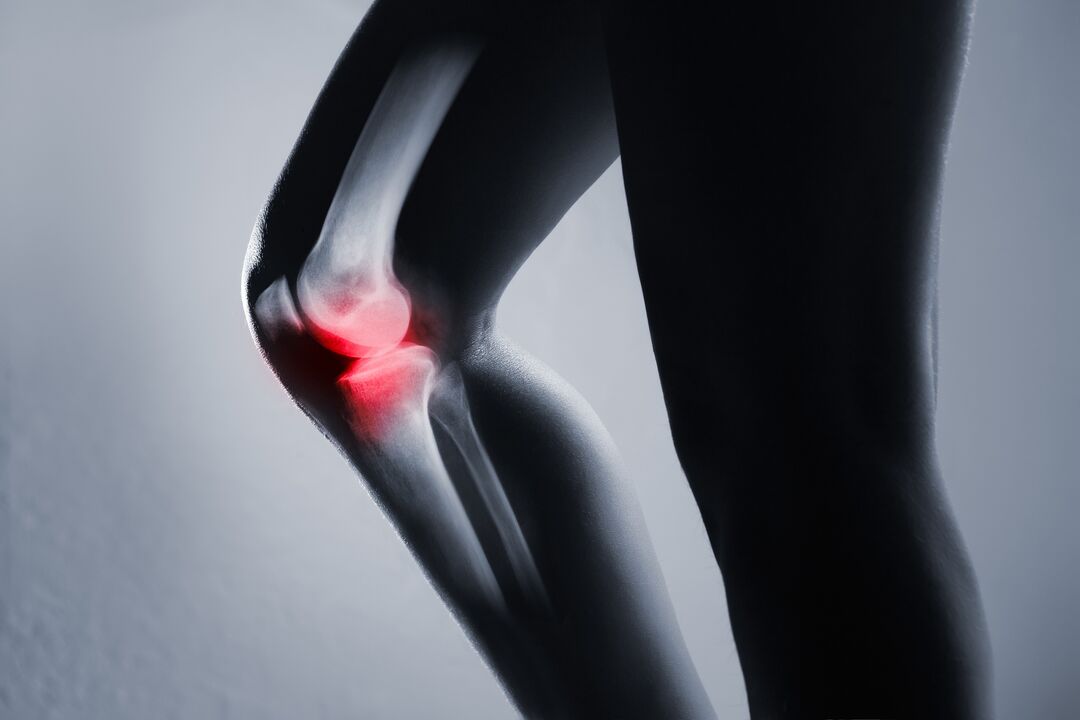 inflammation de l'articulation du genou avec arthrose
