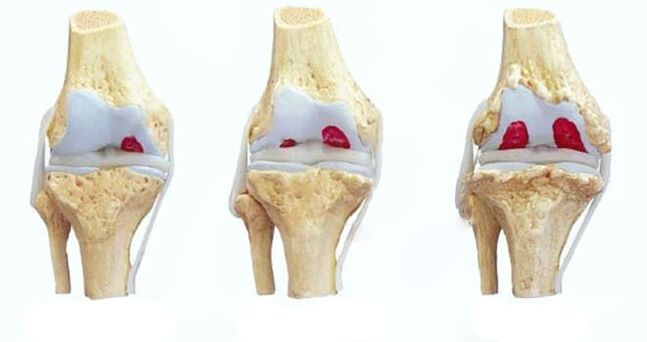 stades de l'arthrose du genou