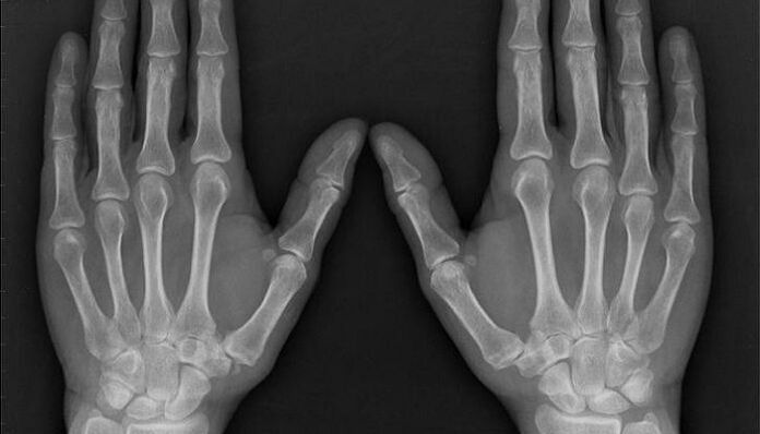 radiographie pour le diagnostic de l'arthrite et de l'arthrose
