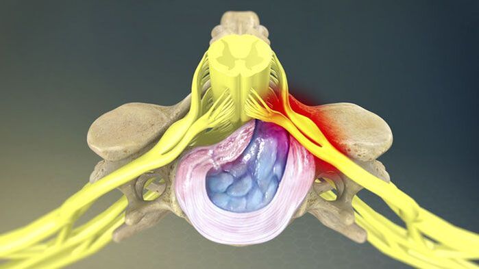 L'une des causes des maux de dos est une hernie discale. 