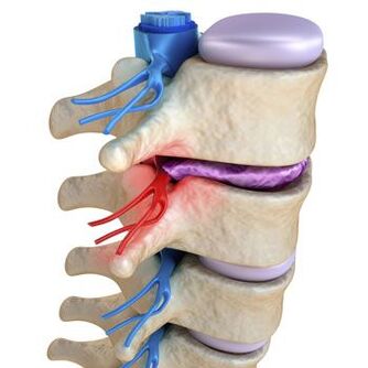 Un nerf pincé dans la colonne vertébrale s'accompagne de douleurs lancinantes
