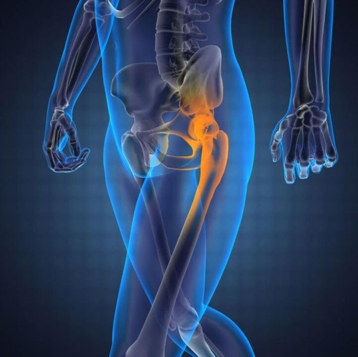 arthrose de l'articulation de la hanche