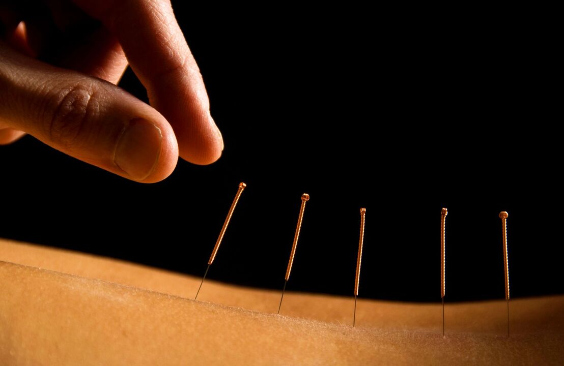 acupuncture pour les maux de dos