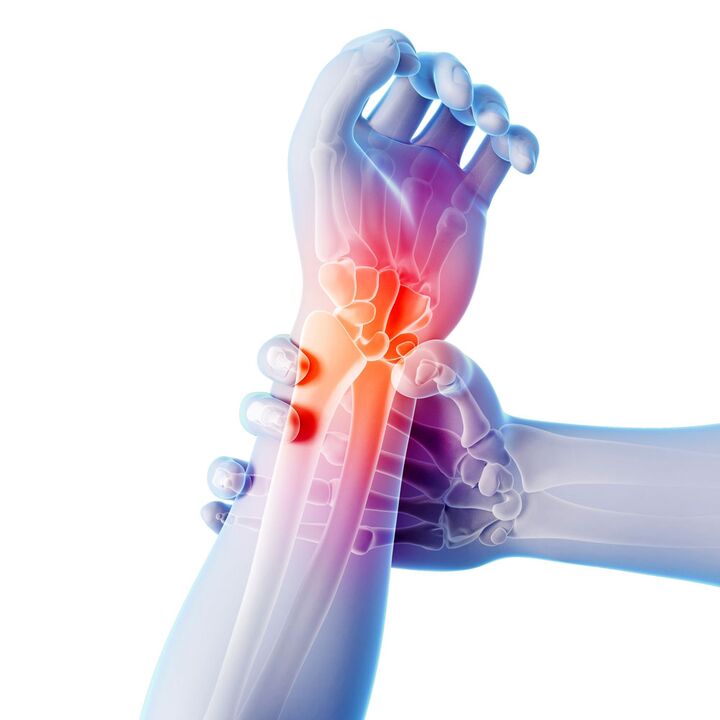 arthrose