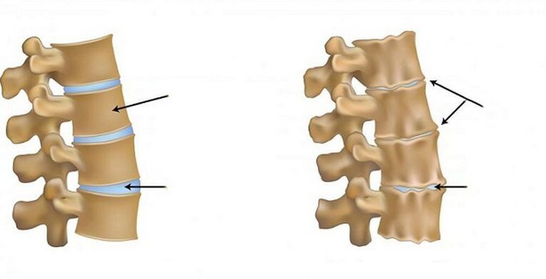 Syndrome ischémique pour l'ostéochondrose