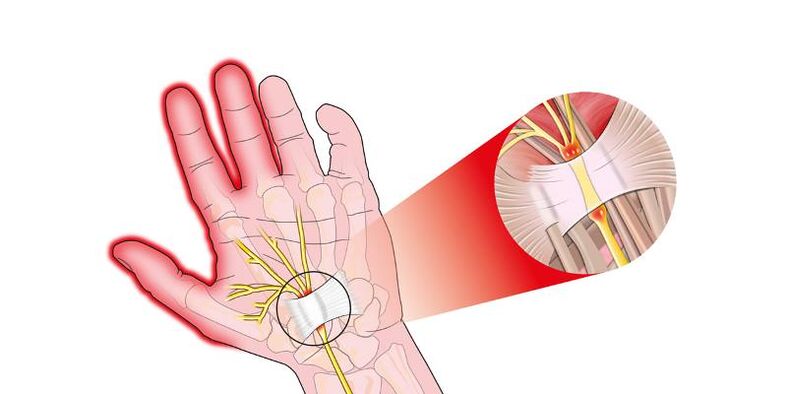 Douleur dans les articulations des doigts souffrant de risartrose