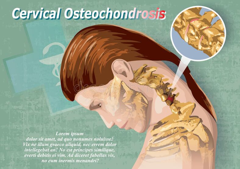 l'ostéochondrose cervicale est une maladie du tissu cartilagineux