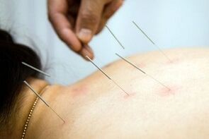 acupuncture pour l'ostéochondrose