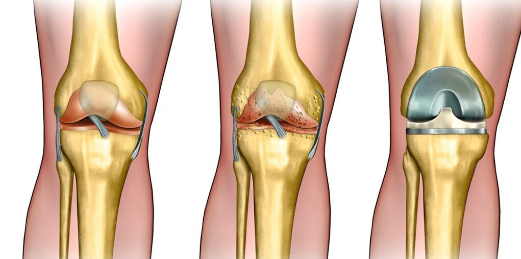 arthrose de l'articulation du genou
