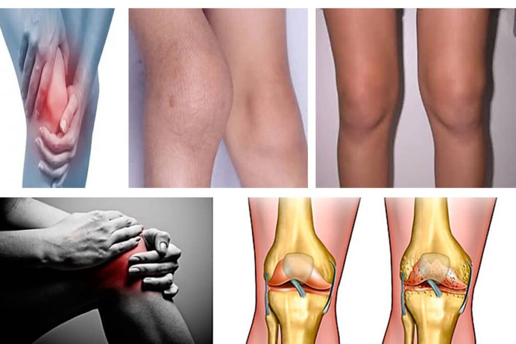 symptômes de l'arthrose du genou